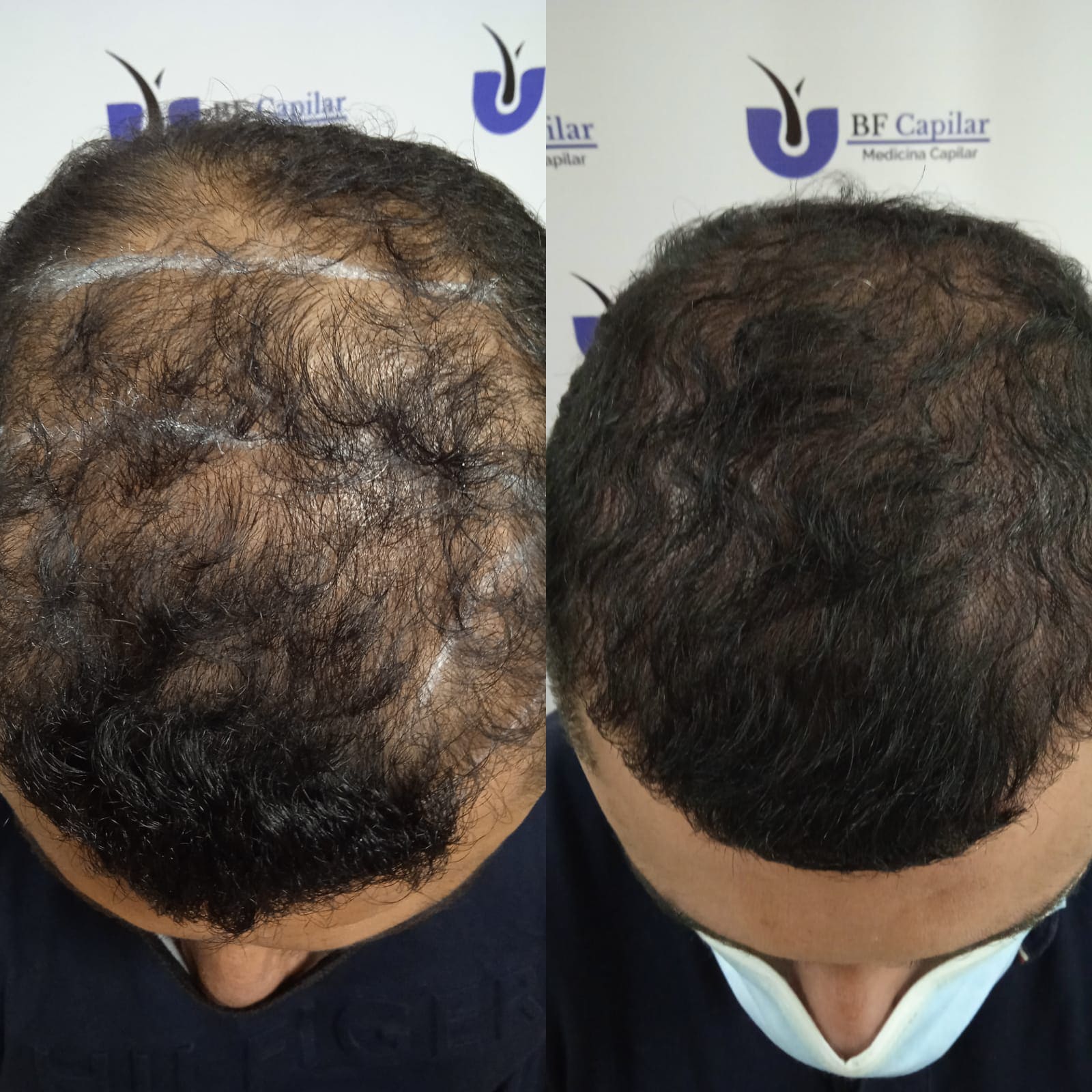 testimonio-de-tratamiendo-para-la-caida-del-cabello (1)
