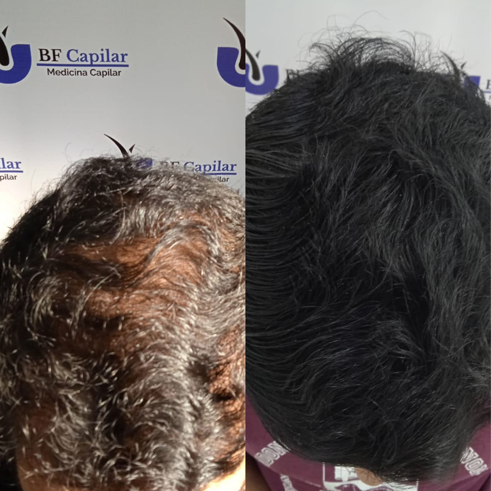 testimonio-de-tratamiendo-para-la-caida-del-cabello (4)